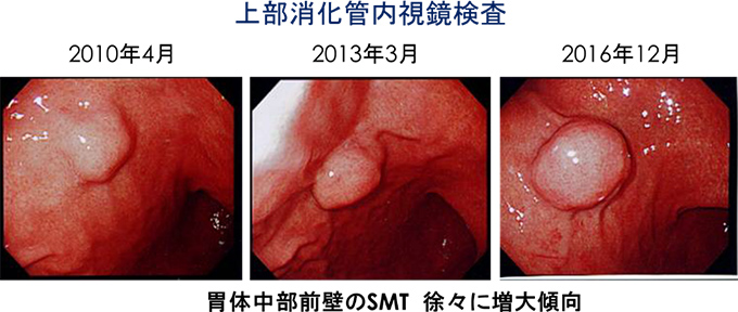 図2 増大する胃粘膜下腫瘍