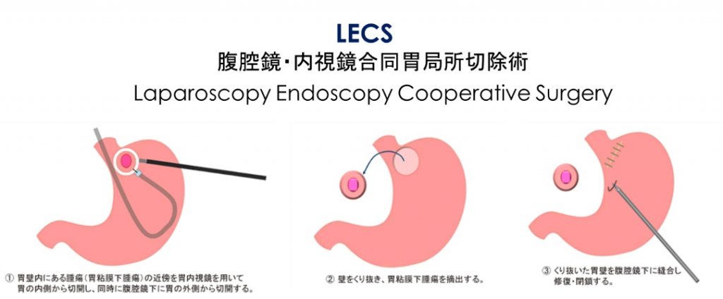 消化管腹腔鏡手術チームを立ち上げました！ 山鹿市民医療センターからのお知らせ