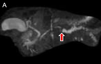 図5A.MRIによる膵管造影