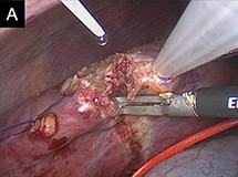 図6A.腹腔鏡肝切除の術中写真