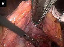 図6B.腹腔鏡膵切除の術中写真
