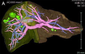 シミュレーション画像：肝臓の門脈がピンク色に、肝静脈が青色に、肝転移巣が緑色に描出されている