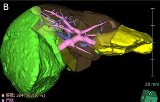 シミュレーション画像：肝切除予定領域が緑色と黄色で示されている