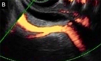 超音波内視鏡像画像：血管との関係が明瞭に描出できます