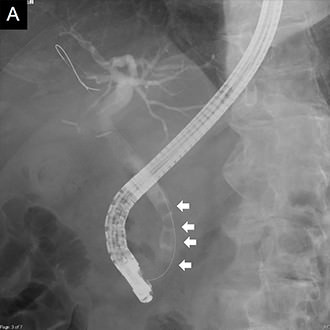 内視鏡治療画像：内視鏡的胆管造影で複数の総胆管結石を確認