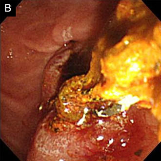 内視鏡治療画像：乳頭切開を行い、全結石を除去