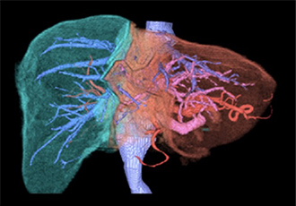 門脈塞栓術後の内視鏡画像