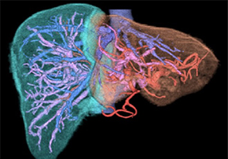 門脈塞栓術前の内視鏡画像
