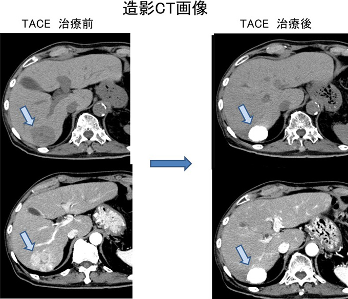 TACE 治療前とTACE 治療後の造影CT画像