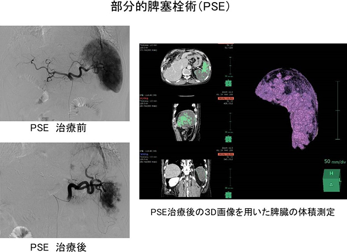 部分的脾塞栓術（PSE）の画像：PSE 治療前、PSE 治療後、PSE治療後の3D画像を用いた脾臓の体積測定画像