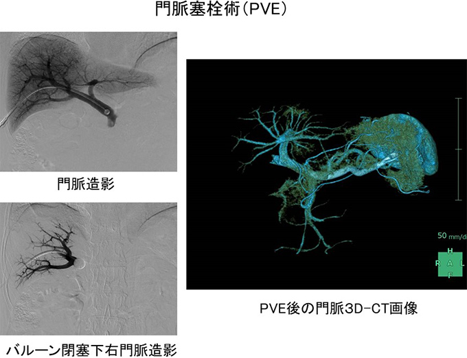 門脈塞栓術（PVE）の画像：門脈造影、バルーン閉塞下右門脈造影、PVE後の門脈3D-CT画像