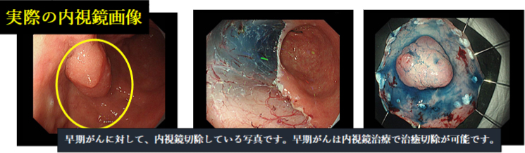実際の内視鏡画像：早期がんに対して、内視鏡切除している写真です。早期がんは内視鏡治療で治癒切除が可能です。