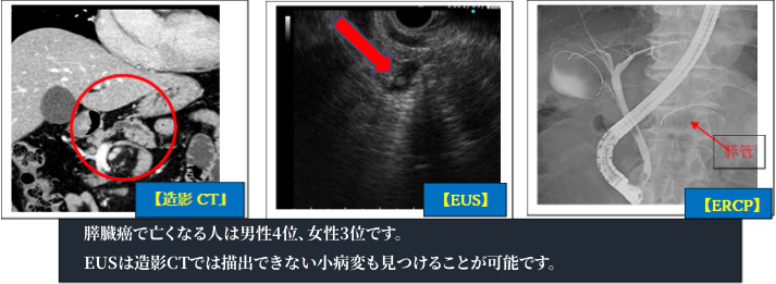 造影CT・EUS・ERCPの画像：膵臓癌で亡くなる人は男性4位、女性3位です。EUSは造影CTでは描出できない小病変も見つけることが可能です。