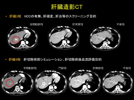 肝臓造影CTについて ・肝臓3相：HCCの有無、肝硬変、肝炎等のスクリーニング目的 ・肝臓4相：肝切除術前シミュレーション、肝切除術後血流評価目的