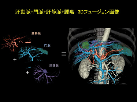 肝動脈 + 門脈 + 肝静脈 + 腫瘍 3Dフュージョン画像