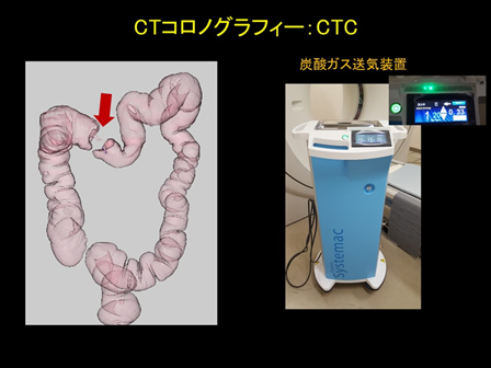 CTコロノグラフィー：CTCおよび炭酸ガス送気装置の画像