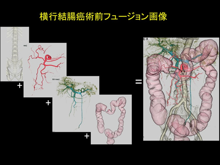 横行結腸癌術前フュージョン画像