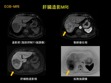 肝臓造影MRIの画像：造影前（脂肪抑制T1強調画像）、動脈優位相、肝細胞造影相、拡散強調像
