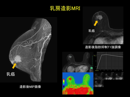 乳房造影MRIの画像：造影後M1P画像と造影後脂肪抑制T1強調像に映る乳癌