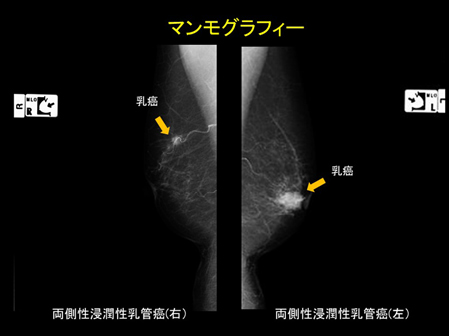マンモグラフィーの画像：両側性浸潤性乳管癌（右）と両側性浸潤性乳管癌（左）に映る乳癌