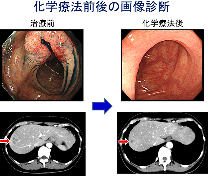 化学療法前後の画像診断