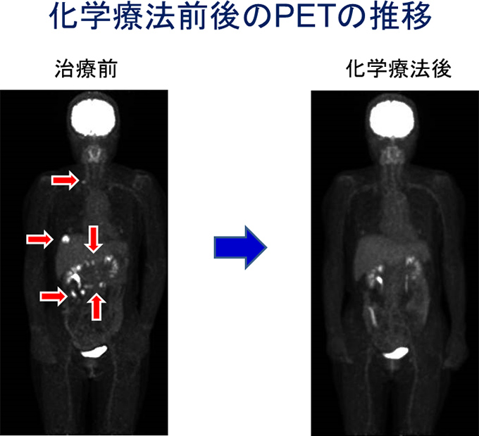 化学療法前後のPETの推移
