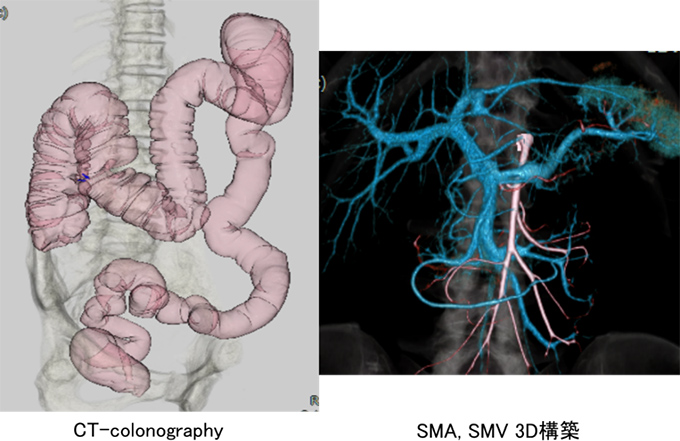 CT-colonographyとSMA、SMV、3D構築の画像