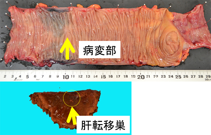 病変部位や肝転移巣の画像