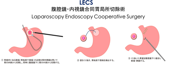 LECS 腹腔鏡・内視鏡合同胃局所切除術のイメージ図：①胃壁内にある腫瘍（胃粘膜下腫瘍）の近くを胃内視鏡を用いて胃の内側から切開し、同時の腹腔鏡下に胃の外側から切開、②壁をくり抜き、胃粘膜下腫瘍を敵出する。③くり抜いた胃壁を腹腔鏡下に縫合し修復・閉鎖する。