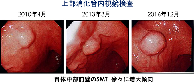 年別上部消化管内視鏡検査の画像：胃体中部前壁のSMTが2010年4月から2013年3月、2016年12月にかけて徐々に増大傾向となっている様子