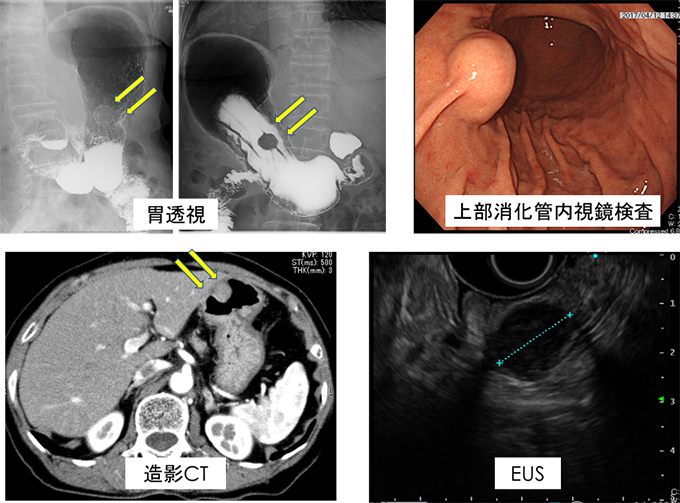 胃透視、上部消化管内視鏡検査、造影CT、EUSの画像