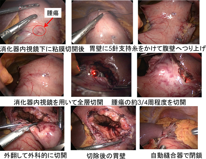 胃の腫瘍摘出術の術中写真を用いた説明画像：①消化器内視鏡下に粘膜切開後、胃壁に5針支持糸をかけて腹壁へつり上げる。②消化器内視鏡を用いて全層切開、腫瘍の3/4周程度を切開、③外翻して外科的に切開、切除後の胃壁の様子を確認し、自動縫合器で閉鎖
