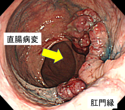 直腸病変の内視鏡検査画像