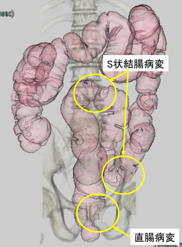 S状結腸・直腸の病変を写したCTコロノグラフィー画像