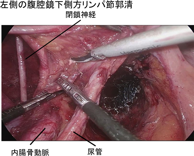 左側の腹腔鏡下側方リンパ節郭清の術中画像：閉鎖神経や内腸骨動脈、尿管も確認できる