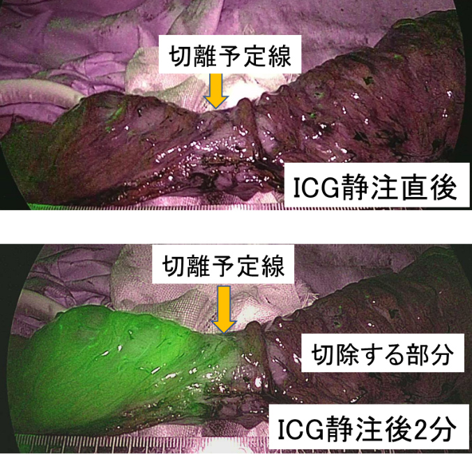 ICG静注直後とICG静注後2分の切除する部位の切開予定線を比較した画像
